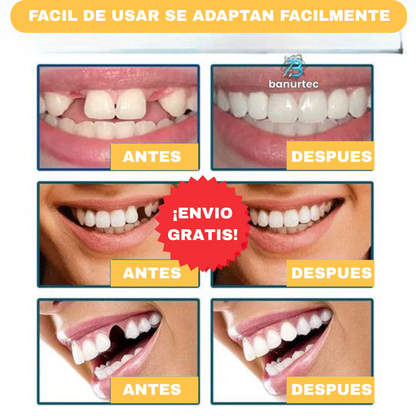 Carillas dentales SnapOn Smile™ ( Paga al recibir en casa🚚🏠)